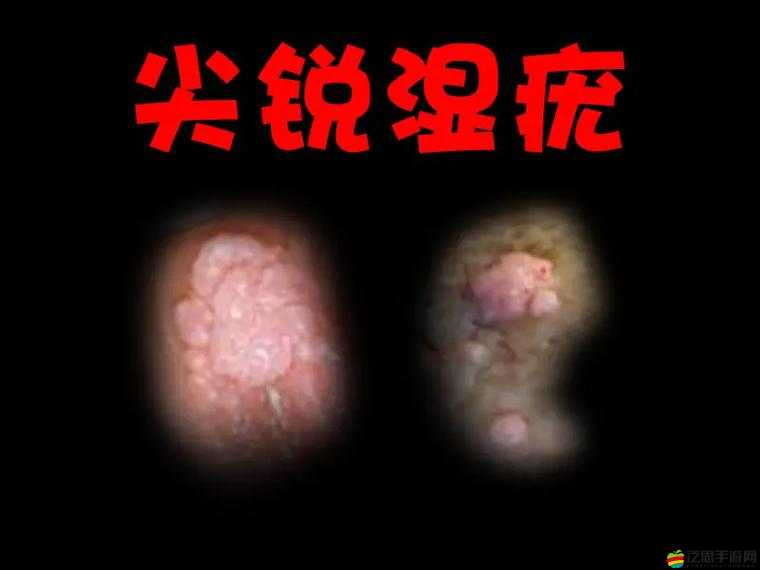 尿道口兩邊的肉腫了的原因：解析多種可能因素