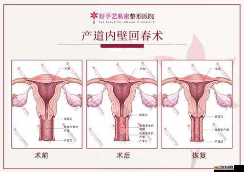 八爪魚(yú)緊縮術(shù)：女性私密整形的創(chuàng)新與魅力之選